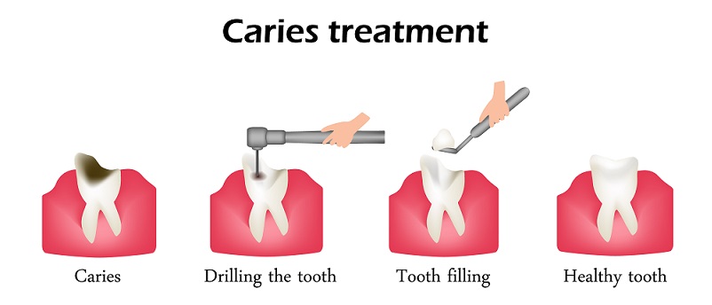 TOOTH FILLINGS IN GURGAON: TREATMENT, TYPES, PROCESS & COST