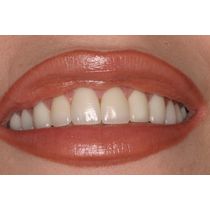 After-Porcelain Veneers