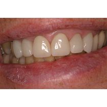 After-Porcelain Veneers