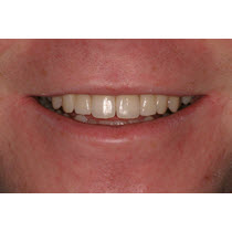 After-Porcelain Veneers