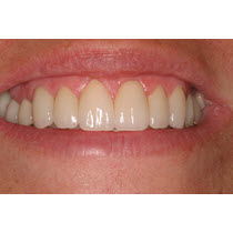 After-Porcelain Veneers