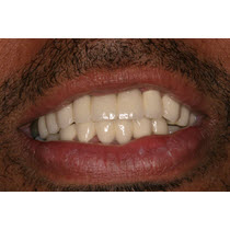 After-Porcelain Crowns and Bridge