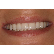 After-Porcelain Veneers