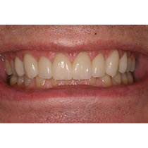 After-Porcelain Veneers