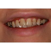 Before-Porcelain Veneers