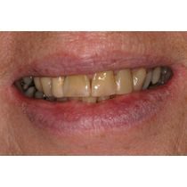 Before-Porcelain Veneers