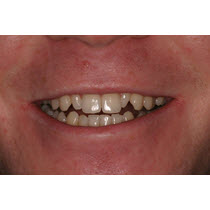 Before-Porcelain Veneers