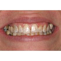 Before-Porcelain Veneers