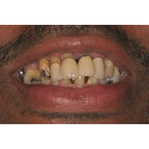 Before-Porcelain Crowns and Bridge