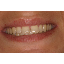 Before-Porcelain Veneers