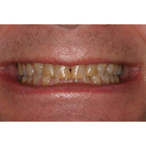 Before-Porcelain Veneers