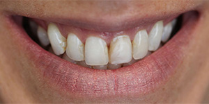 Before-Veneers