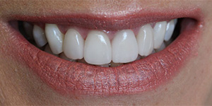 After-Veneers