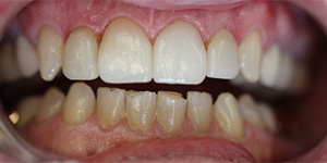 After-Crown replacement for chipped front crowns