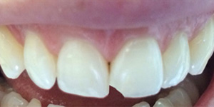 Before-Composite bonding to fix chipped front tooth