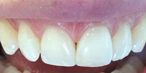 After-Composite bonding to fix chipped front tooth