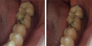 Before-One day Cerec crown to fix fractured molar