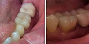 After-One day Cerec crown to fix fractured molar