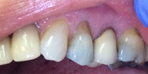 Before-Cover recession with one day Cerec crown