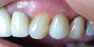 After-Cover recession with one day Cerec crown