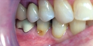 Before-Cover recession with composite bonding