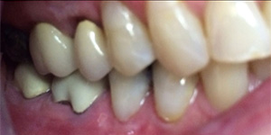 After-Cover recession with composite bonding