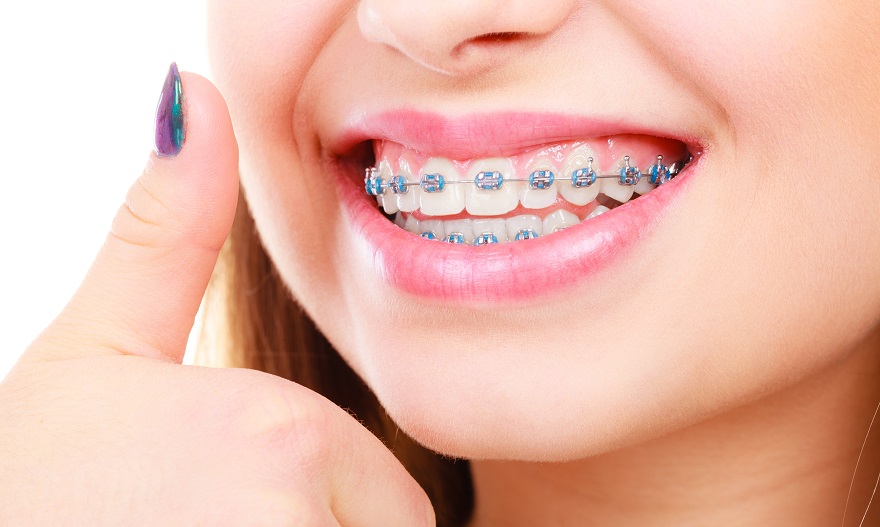 7 Not-so-obvious Benefits of Dental Braces | Consumer Guide to Dentistry