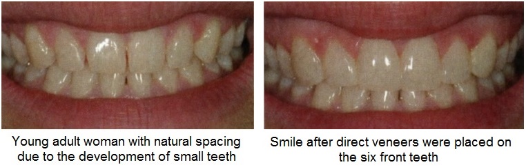 direct veneers patient before and after